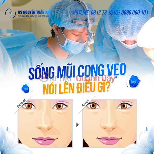 Sống mũi cong vẹo: Tướng tài lộc ? Niêm yết cho thuê